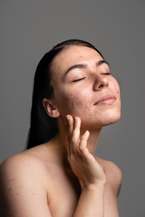 Acne treatment guide Brisbane