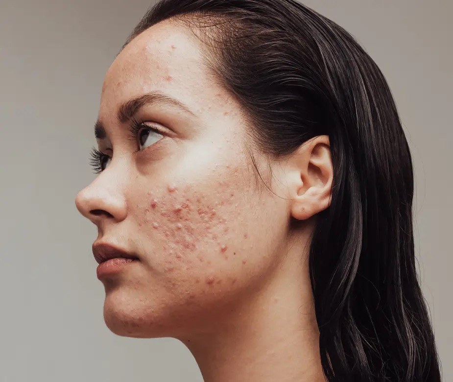 Acne treatment Brisbane — hormonal, fungal and bacterial acne explained