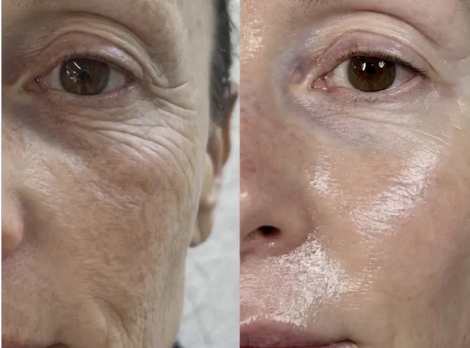 Skin tightening treatments Brisbane — RF, plasma and needling compared