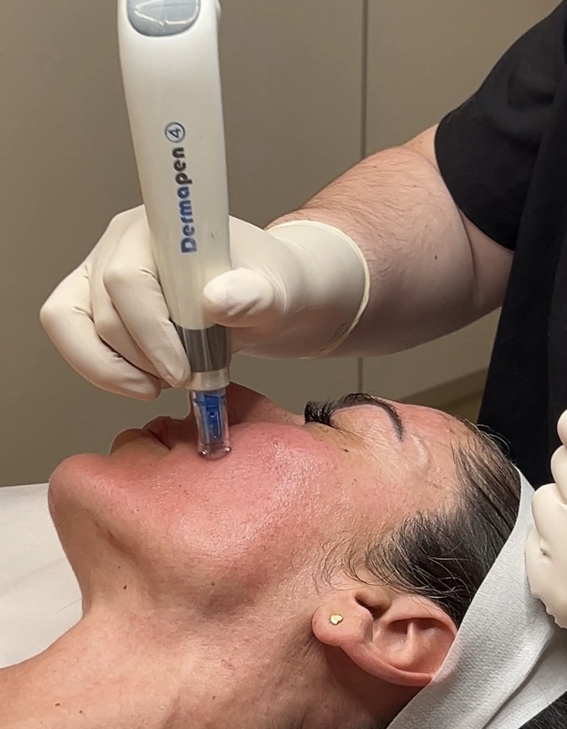 Dermapen skin needling Brisbane — collagen induction therapy at SKYNN