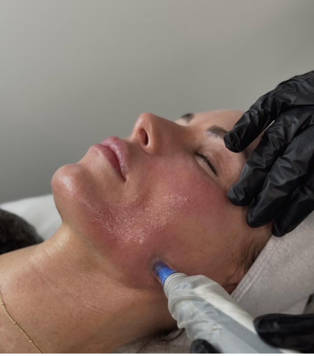 Dermapen needling treatment in progress at SKYNN