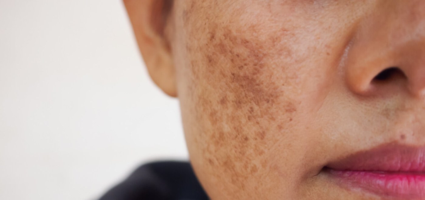 Hyperpigmentation vs melasma Brisbane — pigmentation treatment at SKYNN