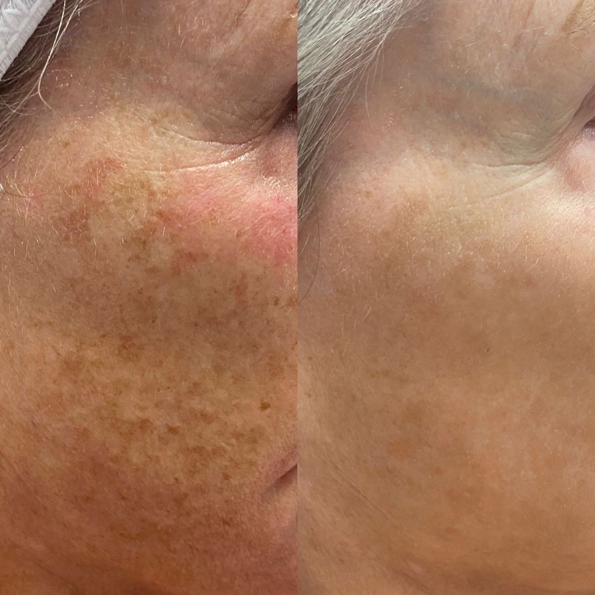 Before and after IPL pigmentation treatment at SKYNN Clinical Skin, Albion Brisbane