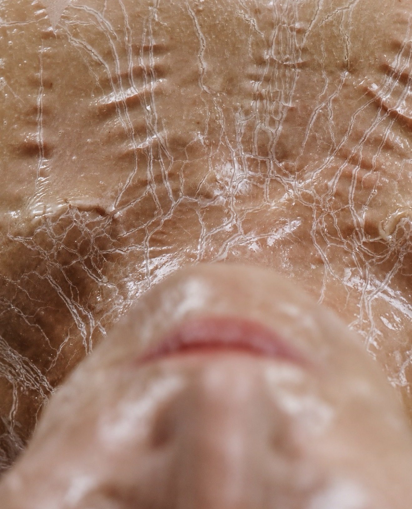 O Cosmedics Lymphatic Enzyme Peel treatment in progress at SKYNN Clinical Skin, Albion Brisbane