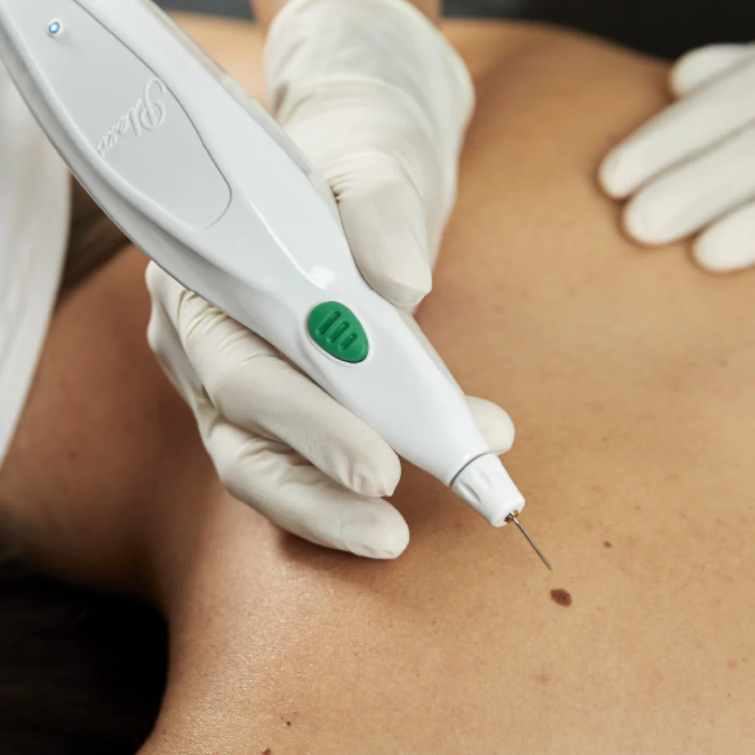 Plexr plasma soft surgery Brisbane — skin tightening, eyelid lifting, scar revision