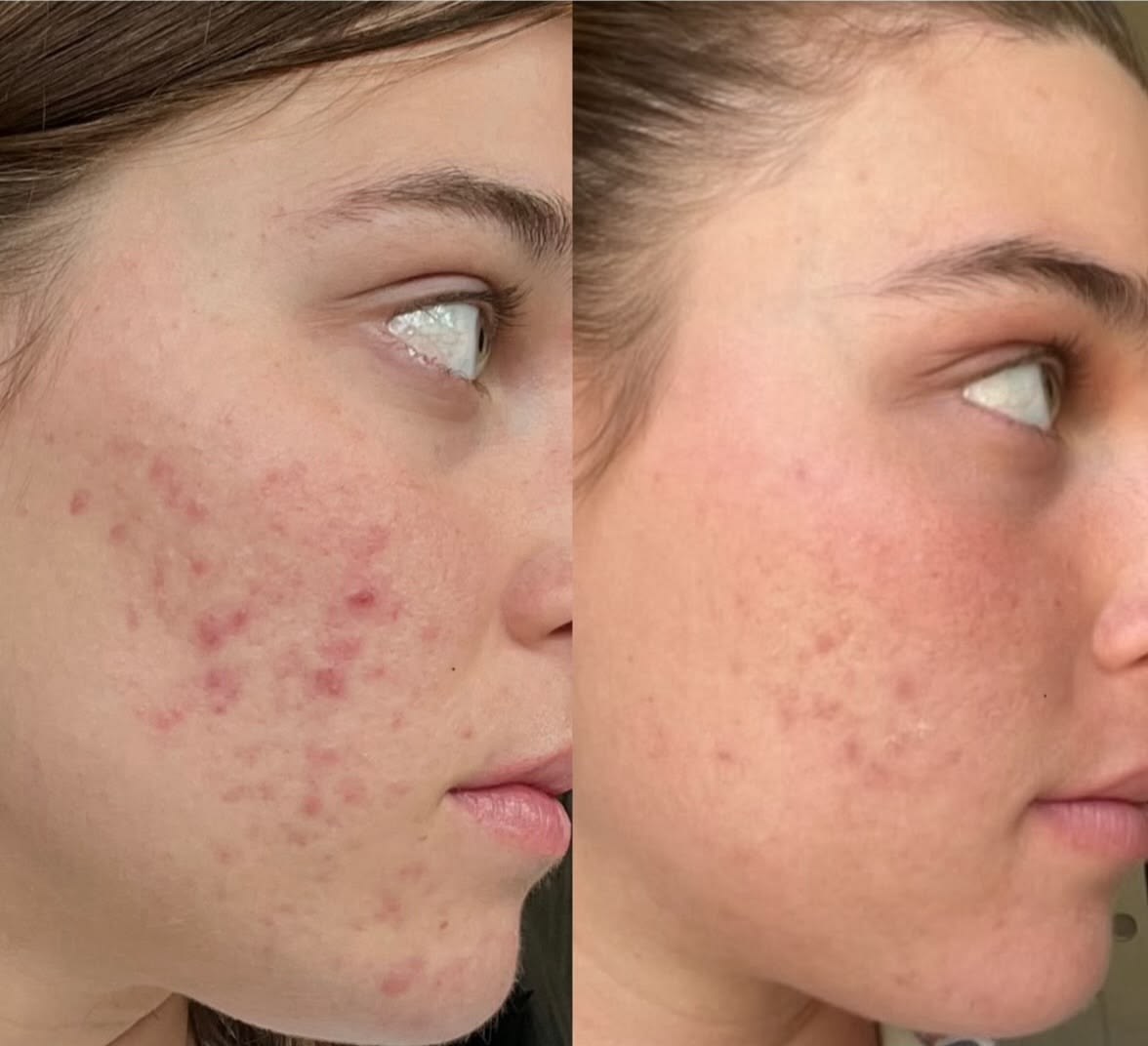 Active acne treatment before and after Brisbane — SKYNN