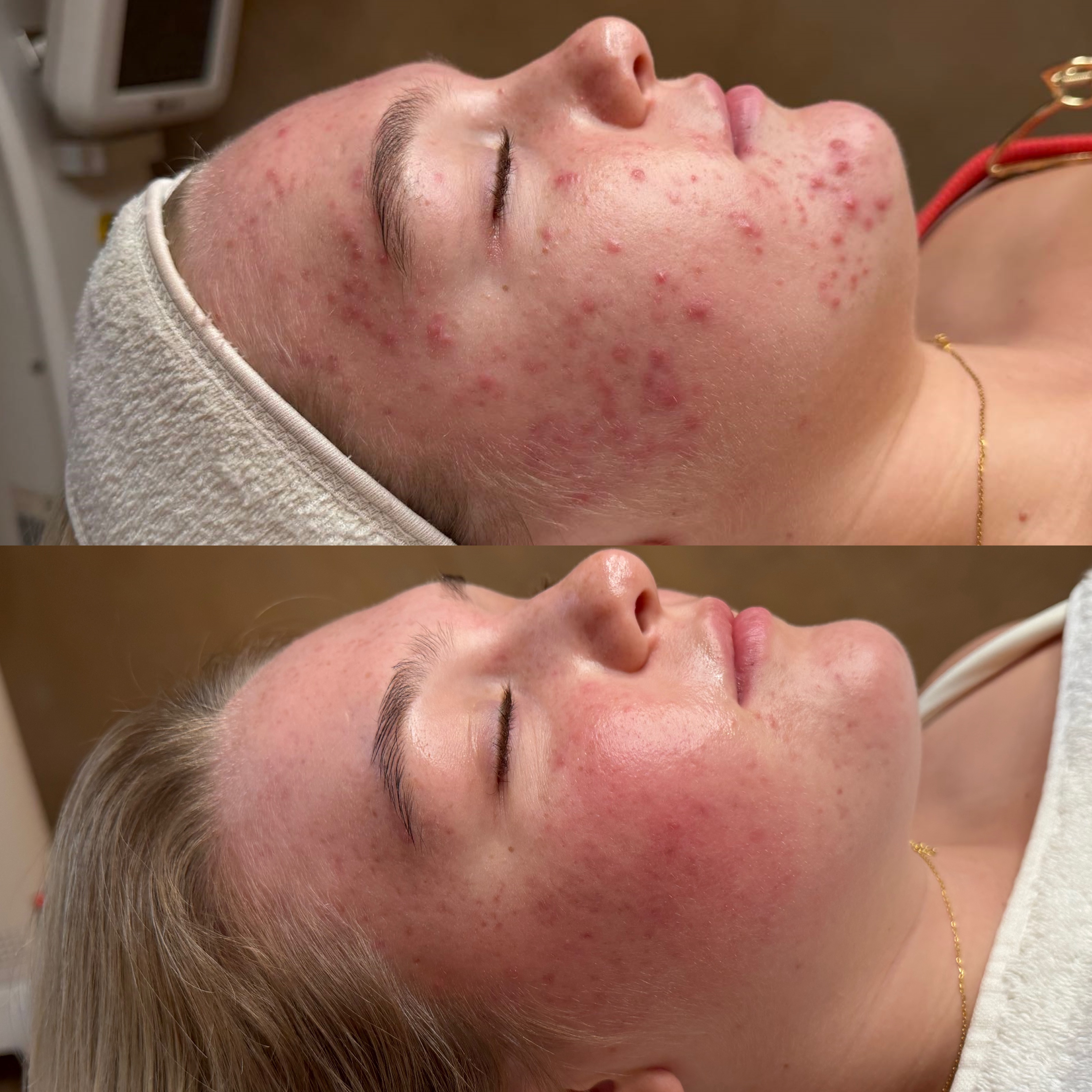 Acne and skin congestion before and after Brisbane — SKYNN
