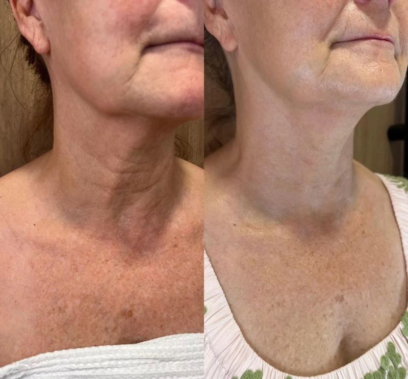 Neck and jawline tightening before and after Brisbane — SKYNN
