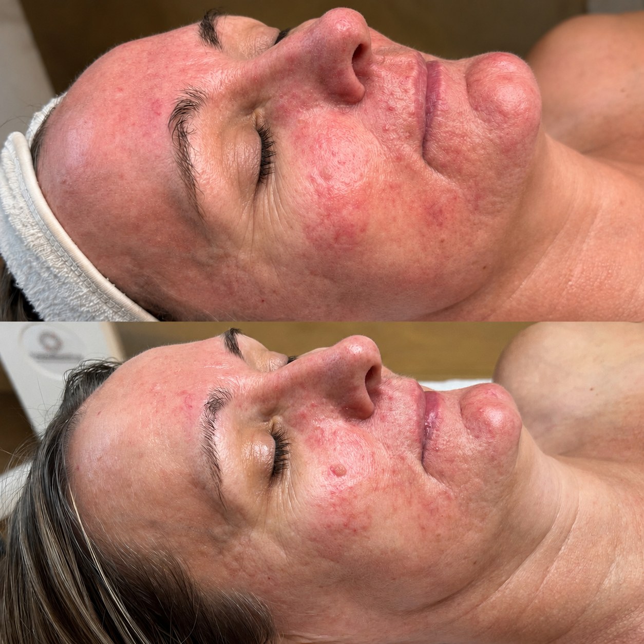 Rosacea and chronic redness before and after Brisbane — SKYNN