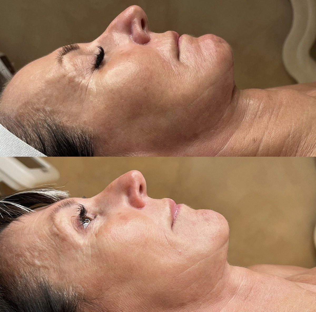 Skin rejuvenation before and after Brisbane — SKYNN