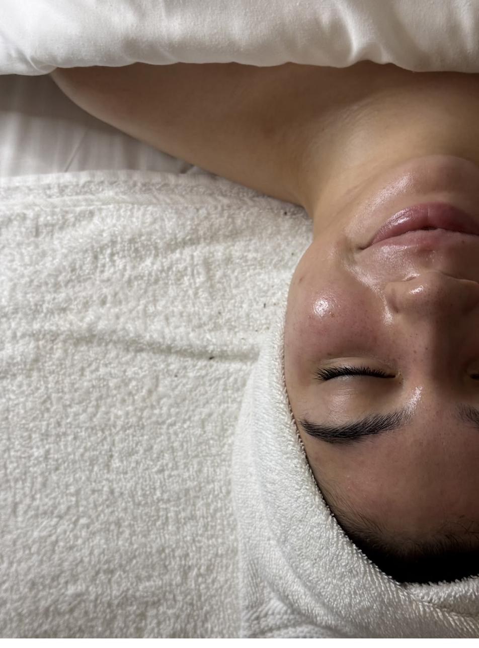 Before and after RF microneedling results at SKYNN Brisbane