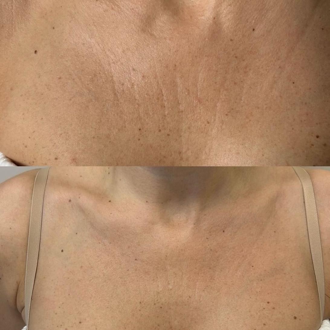 Before and after neck skin tightening with RF microneedling at SKYNN Brisbane