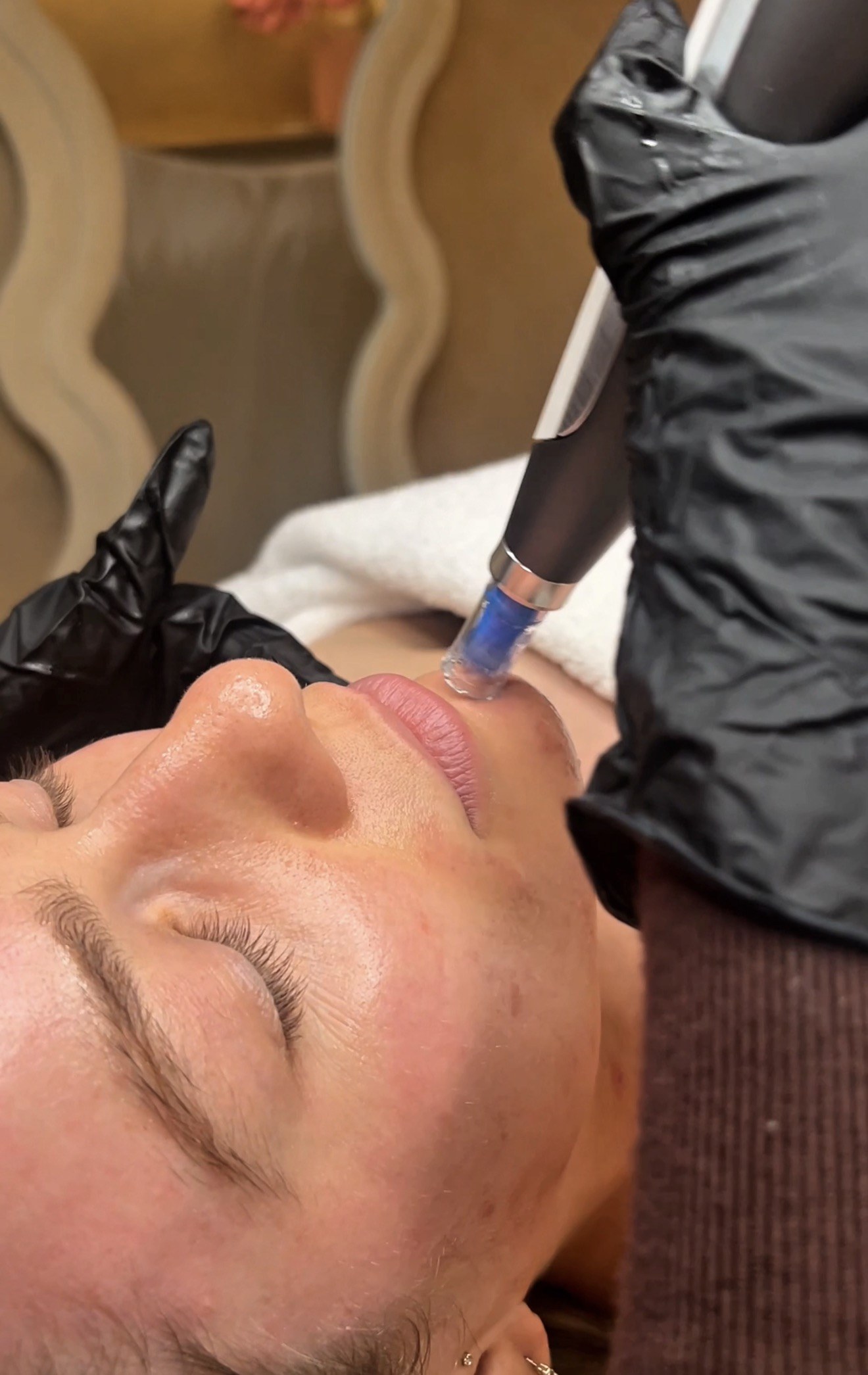 Skin needling Brisbane — collagen induction therapy at SKYNN