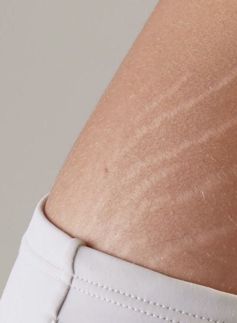 Stretch mark treatment Brisbane — what actually works